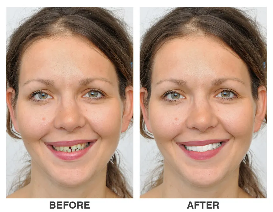 Cosmetic Dentist in Stone Mountain GA Before and After